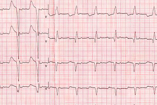 Блокада ножки Гиса