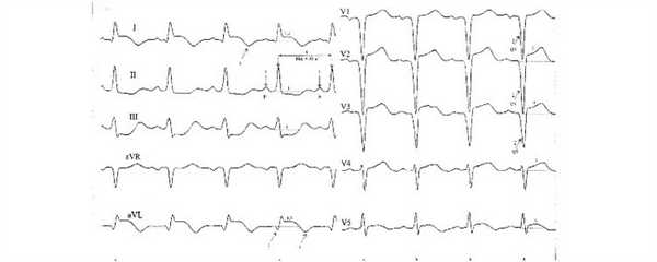 Острый инфаркт миокарда на ЭКГ