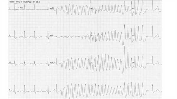 Пируэтная аритмия, возникающая в результате гипокалиемии