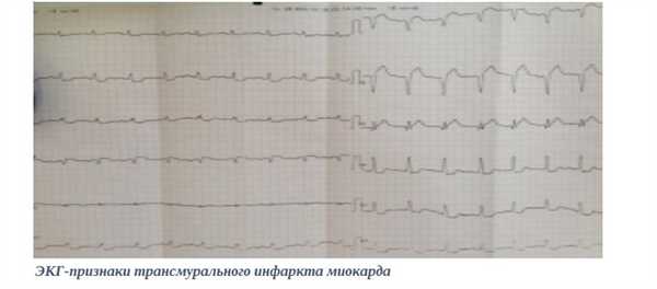 ЭКГ-признаки трансмурального инфаркта миокарда