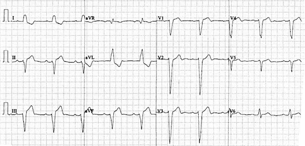 Инфаркт с подъемом ST в сочетании с блокадой левой ножки пучка Гиса.