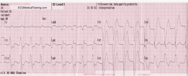 Инфаркт с подъемом ST в сочетании с блокадой левой ножки пучка Гиса.