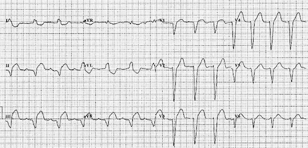 Инфаркт с подъемом ST в сочетании с блокадой левой ножки пучка Гиса.