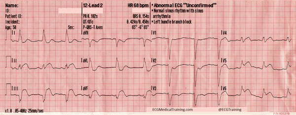 ЭКГ инфаркта STEMI в сочетании с блокадой левой ножки пучка Гиса