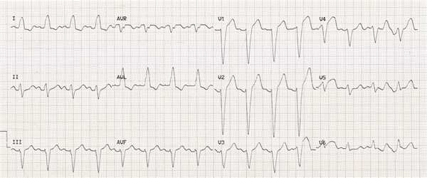 Блокада левой ножки пучка Гиса без инфаркта