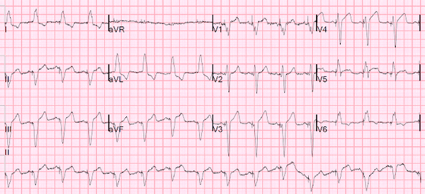 Инфаркт с подъемом ST в сочетании с блокадой левой ножки.