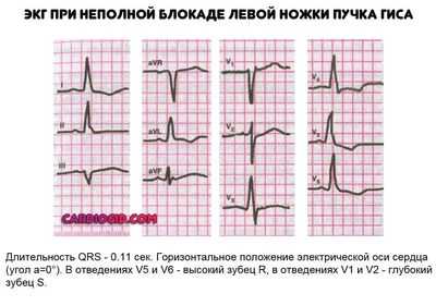 экг-при-неполной-блокаде-левой-ножки-пучка-Гиса