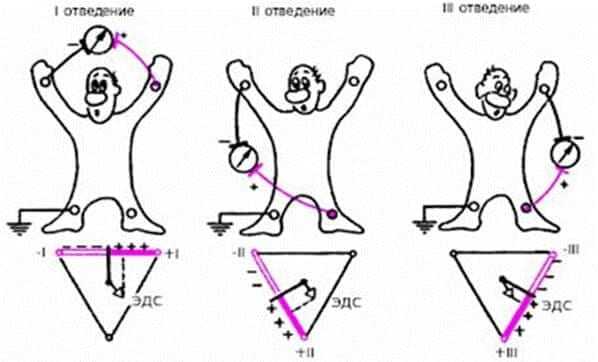 Схема формирования стандартных отведений ЭКГ