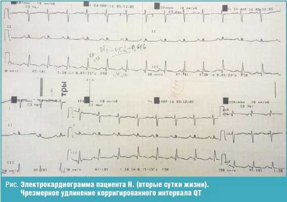 Электрокардиограмма пациента
