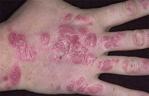 Роговая форма псориаза на руках