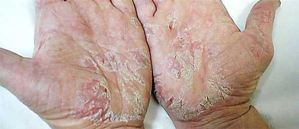 Псориаз на ладонях