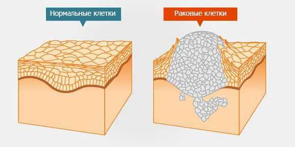 Раковые клетки