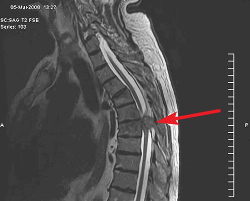 Злокачественные опухоли спинного мозга