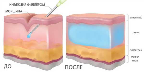 Инъекции филлеров