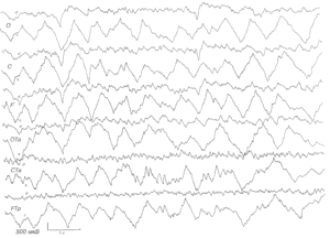 Больная 56 лет с менингоэнцефалитом, вызванным коксиеллой Барнета (Ку-лихорадка)