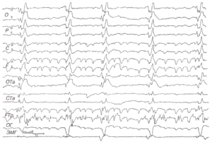 Подострый склерозирующий панэнцефалит Ван-Богарта.