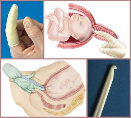 Амниотомия