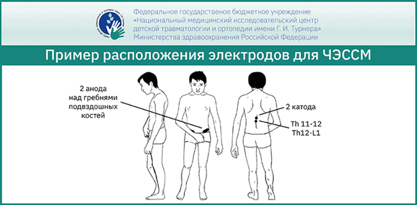 Методика неинвазивной чрескожной электрической стимуляции спинного мозга