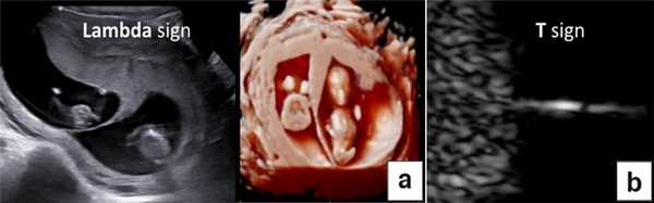 Диагностика хориальности и количества амнионов в I триместре путем оценки лямбда-признака (a) и T-признака (b)
