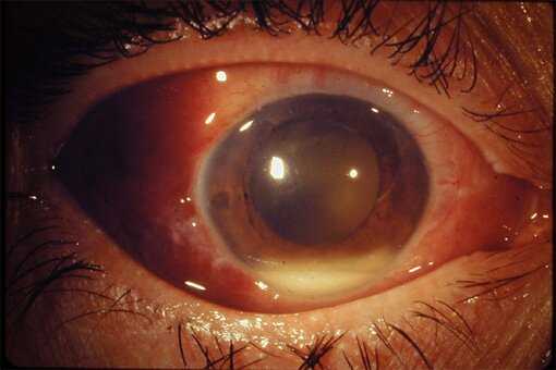 Эндофтальмит