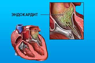 Этиопатогенез инфекционного эндокардита