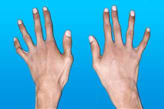 Синдром Марфана