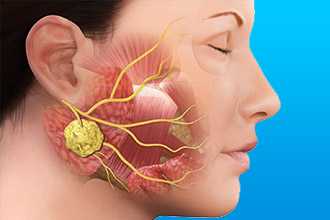 Абсцесс при инфекционном эндокардите