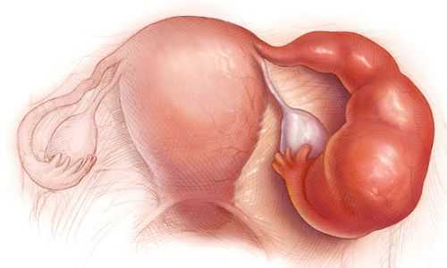 Сальпингоофорит