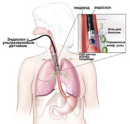 Эзофагоскопия 