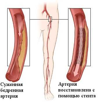 Ангиопластика и стентирование артерий нижних конечностей при атеросклерозе