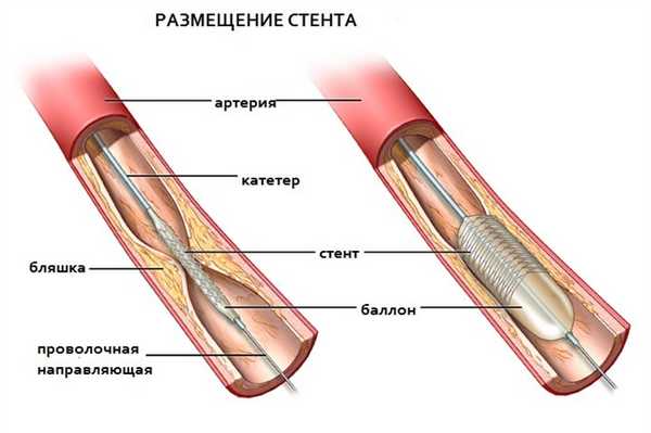 Баллонорасширяемый стент