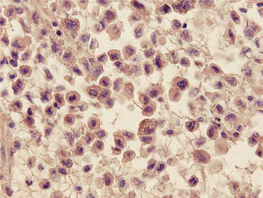 Эозинофильная гранулема