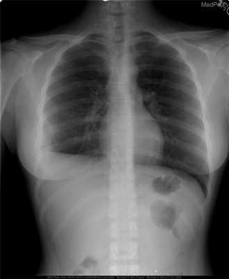 Эозинофильная гранулема-рентген