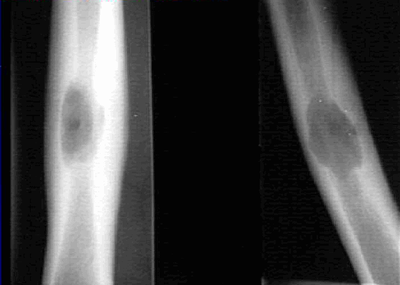 Эозинофильная гранулема плечевой кости