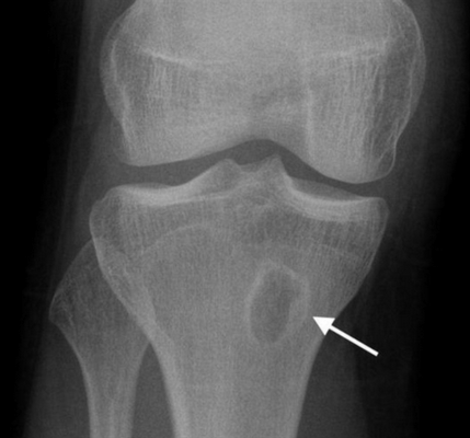 Абсцесс Броди