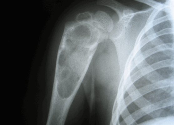 Эозинофильная гранулема плечевой кости