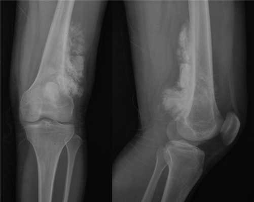 Саркома Юинга