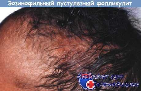 Эозинофильный пустуллезный фолликулит