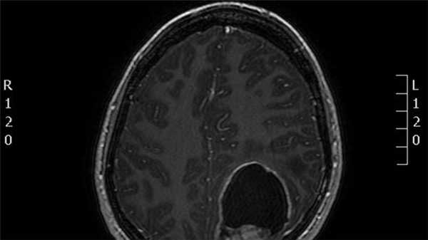 Эпендимомы