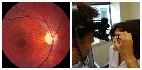 Офтальмоскопия: признаки атрофии зрительного нерва