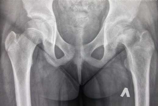 Эпифизеолиз головки бедра