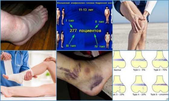 Симптомы развития эпифизеолиза