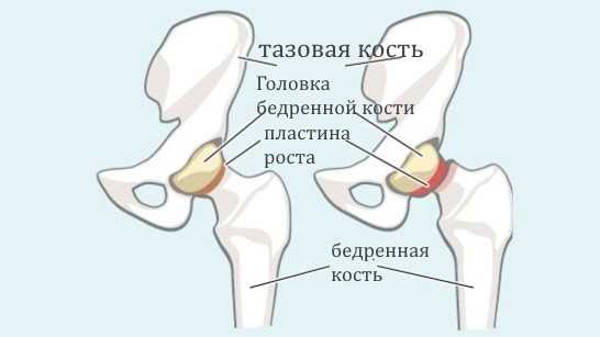Юношеский эпифизеолиз головки бедра