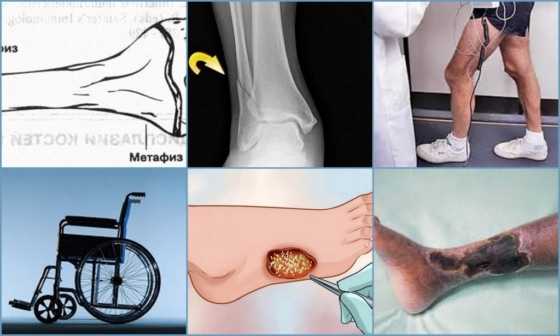 Осложнение при запущенном эпифизеолизе