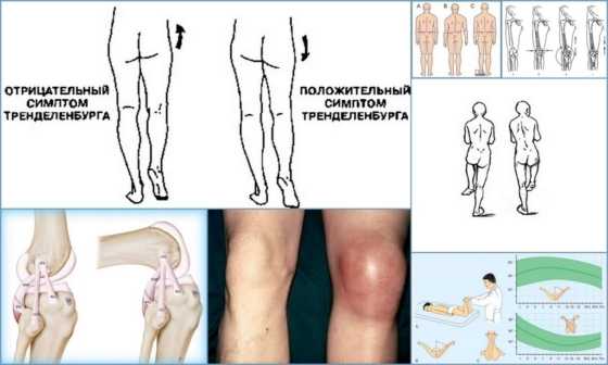 Клинические симптомы остеоэпифизеолиза