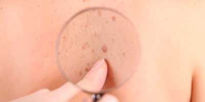 Как-родинки-превращаются-в-меланомы
