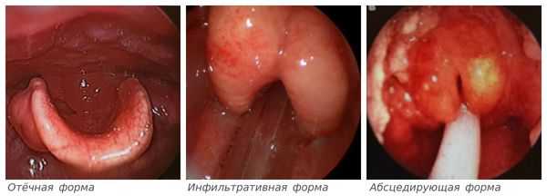 Формы эпиглоттита