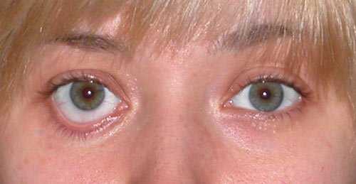 лечение лагофтальм