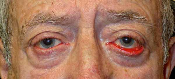 Выворот (эктропион) нижнего века глаза