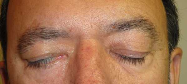 Лагофтальм (заячий глаз)